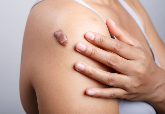 Keloid