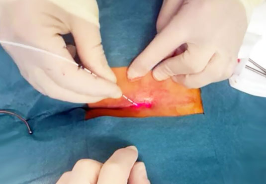 Pilonidal Sinüs Lazer Tedavisi