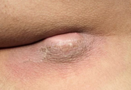 Pilonidal Sinüs Apse Drenaji