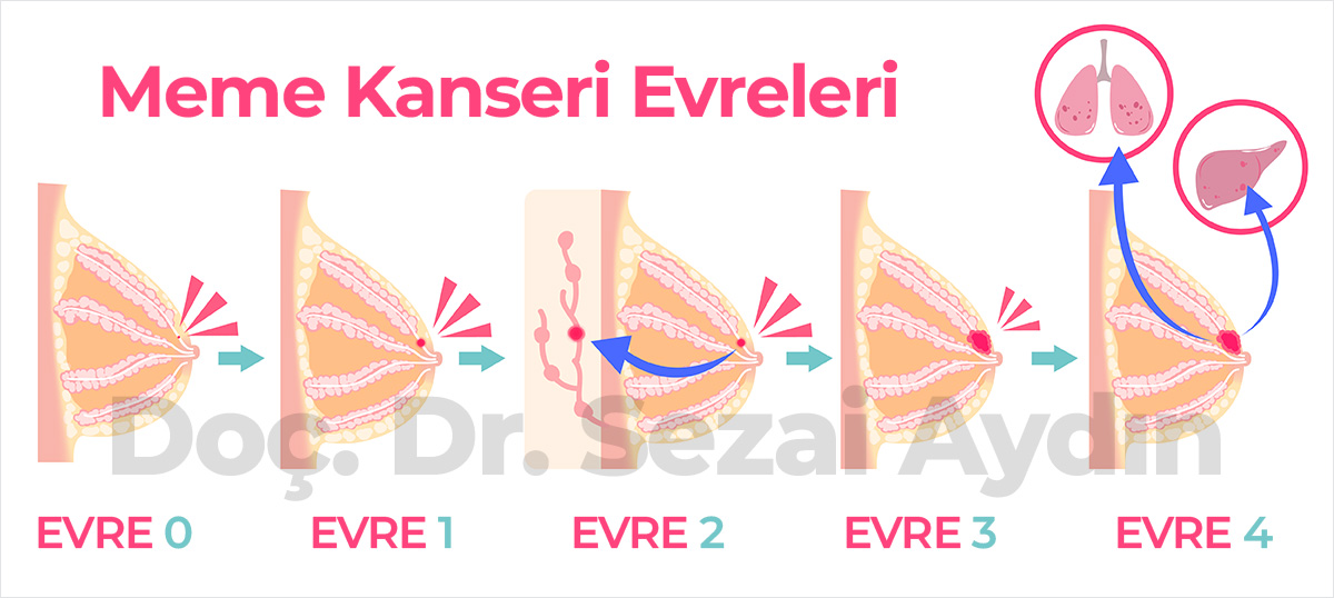 Meme Kanseri Evreleri